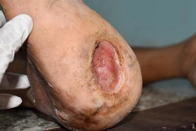 Detailed close-up of heel showing a diabetic ulcer.