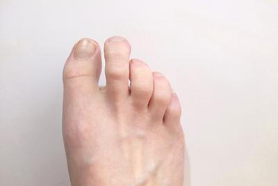 Person with hammertoes condition