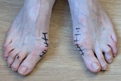 Illustration of Lapiplasty before surgery