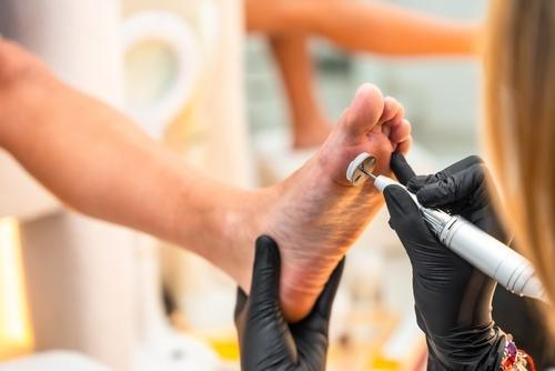 A podiatrist removing a callus from a patient’s foot during treatment.