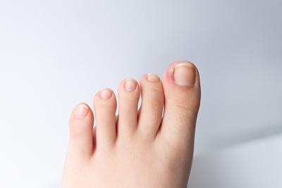 Big-Toe-with-Ingrown-Toenail