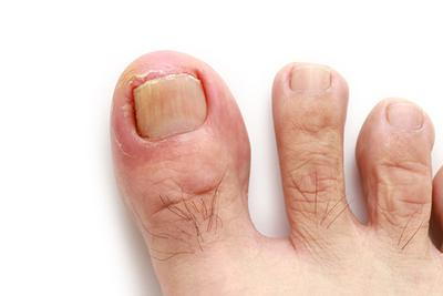 Detailed image of inflamed ingrown toenail