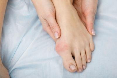 Illustration of bunions on a persons foot
