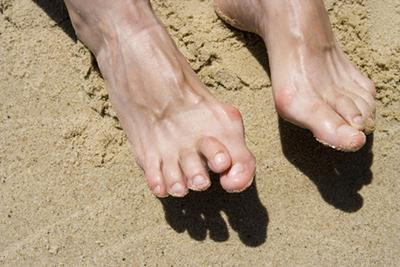 Feet of a person with hammertoes condition lying on sand
