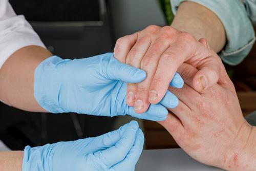 A dermatologist examining a patient's skin affected by psoriasis.
