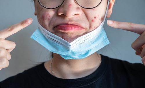 A woman revealing acne on her face after removing a protective mask.