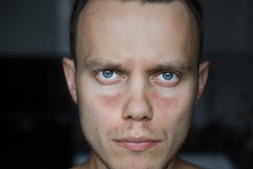 A man showing facial redness consistent with lupus-related skin rash.