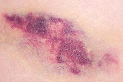 Hematoma in skin