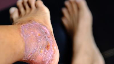 Skin Grafts in a person foot with black background.