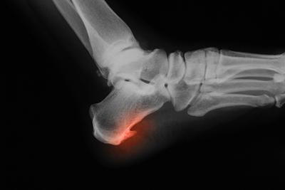 Illustration of heel pain on xray