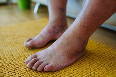 Diabetic Foot with swelling and darkened