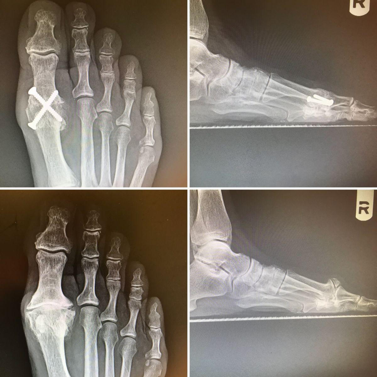 Severe Big Toe Joint Arthritis