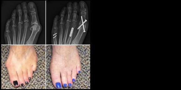 Bunion and Arthritis