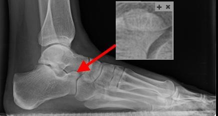 Anterior Superior Process of the Calcaneus Fracture