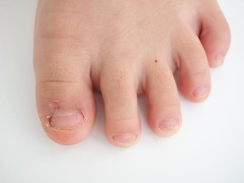 Kids-foot-with-Fungal-Toenail-Conditions