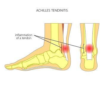 tendon above heel hurts