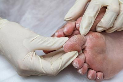 Medical professional examining a patient’s foot affected by diabetes-related dryness and skin issues.