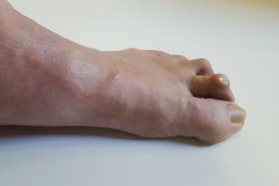 Person with hammertoes condition on foot