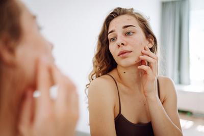 Woman-Touching-Her-Face-with-Acne-Problem
