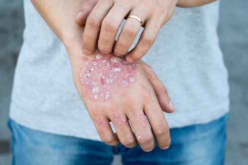 A man scratching his hand affected by psoriasis with visible red, scaly patches.