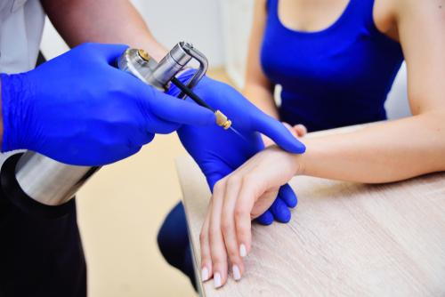 A dermatologist performing cryotherapy to remove a wart on a patient's skin.