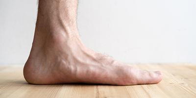 Side view of a foot with flat feet condition.