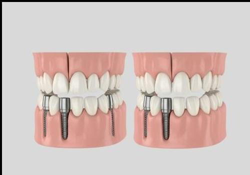 all on 4 vs all on 6 dental implants