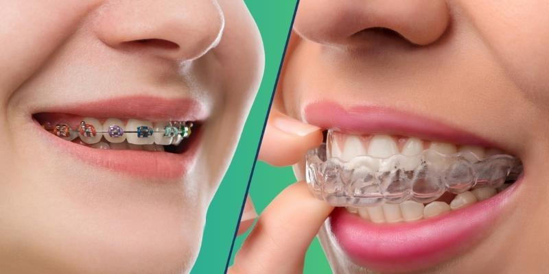 Invisalign vs Braces