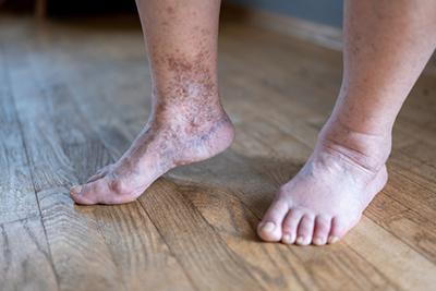 Senior-Woman-with-Diabetic-Feet