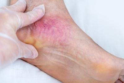 Illustration of foot with Poor Blood Circulation