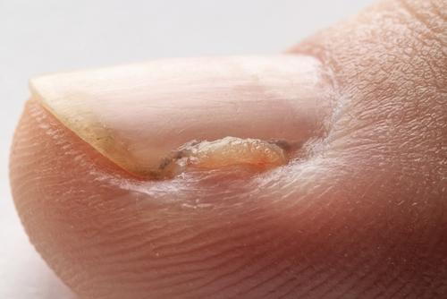 Close-up side view showing an ingrown toenail affecting the edge of the toe