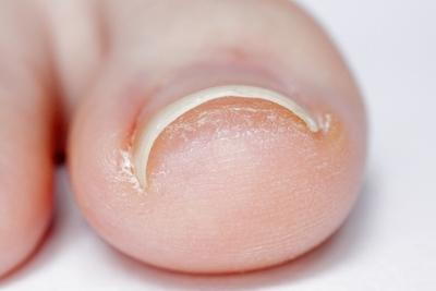 Illustration of sever Ingrown Toenail on person