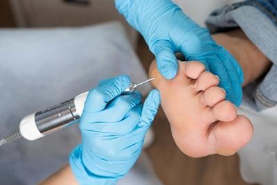 Professional callus removal for a diabetic patient performed by a podiatrist.