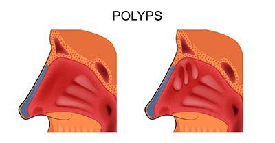 Educational illustration of nose anatomy with and without nasal polyp