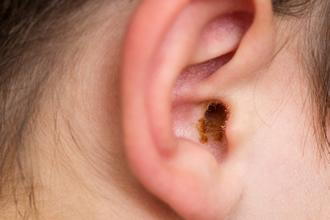 All About Ear Wax Removal