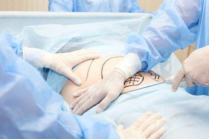 Illustration of Liposuction procedure