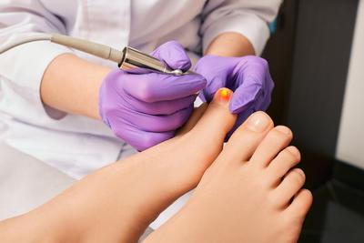 Treating Fungal Nail Thru Laster on a person foot.