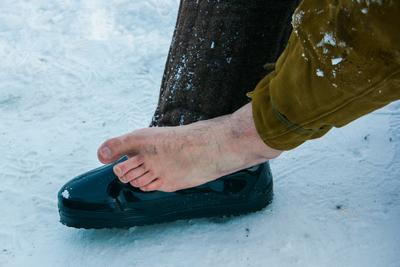 Person suffering from Frostbites