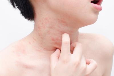 Young boy with itchy red rash on skin scratching
