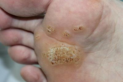 Close-Up-Image-of-a-Foot’s-Sole-Affected-by-Plantar-Warts