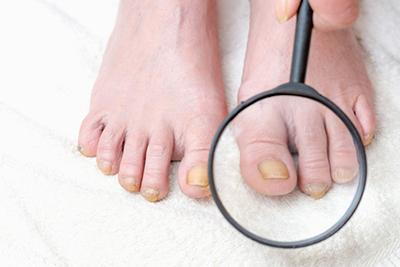 Podiatrist-Using-Magnifier-to-Inspect-Toenail-Infection
