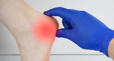 Heel Pain in a person with redness and the doctor with blue gloves.
