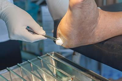 Doctor cleaning the foot of a diabetic foot with cotton