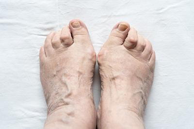 Person with Hammertoes condition