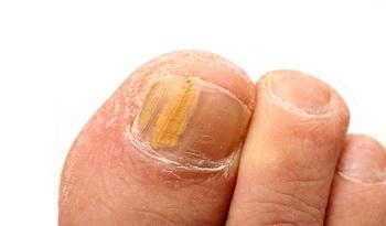 Nail Trauma Guide Causes Symptoms and Treatment Options