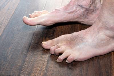 Hammertoes-Causing-Toes-to-Bend-Abnormally