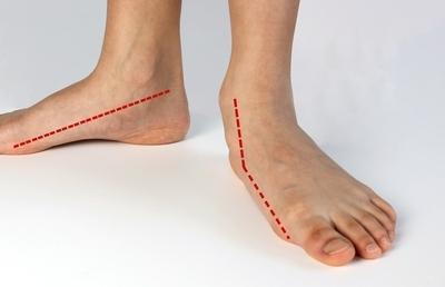 Feet-showing-flat-arch-with-red-guide-lines