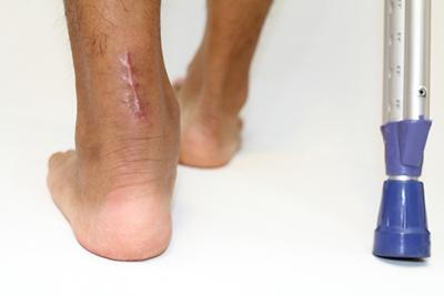 Recovery phase after Achilles tendon repair in male patient