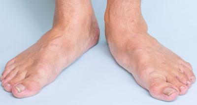 Adult male feet showing signs of flat foot disorder