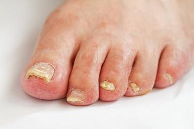 Close-up of yellowed, brittle toenail caused by fungus